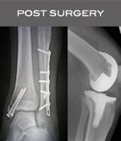 post surgery